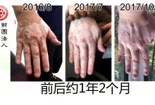 白癜风案例三个-原始点全球同学网