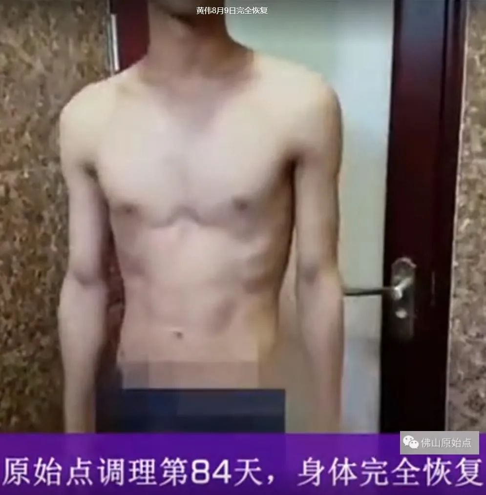 原始点调理严重牛皮癣及静脉曲张:84天完好如初 原始点调理严重牛皮癣及静脉曲张:84天完好如初