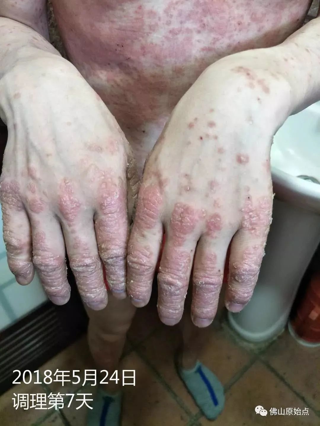 原始点调理严重牛皮癣及静脉曲张:84天完好如初 原始点调理严重牛皮癣及静脉曲张:84天完好如初