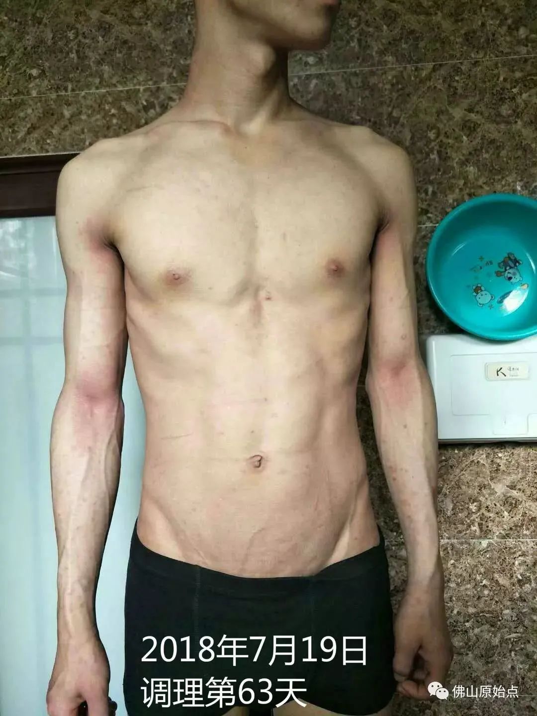 原始点调理严重牛皮癣及静脉曲张:84天完好如初 原始点调理严重牛皮癣及静脉曲张:84天完好如初