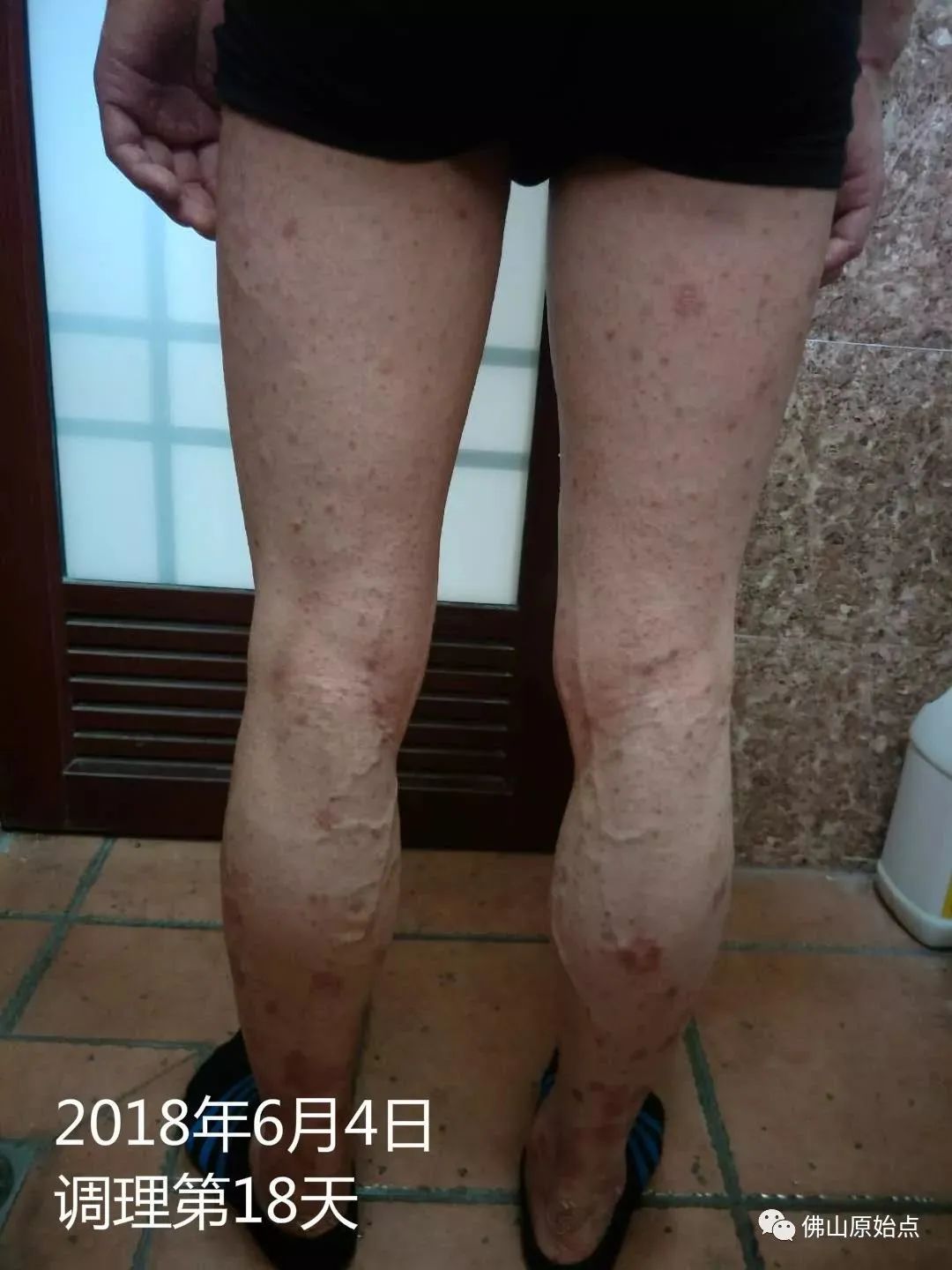 原始点调理严重牛皮癣及静脉曲张:84天完好如初 原始点调理严重牛皮癣及静脉曲张:84天完好如初