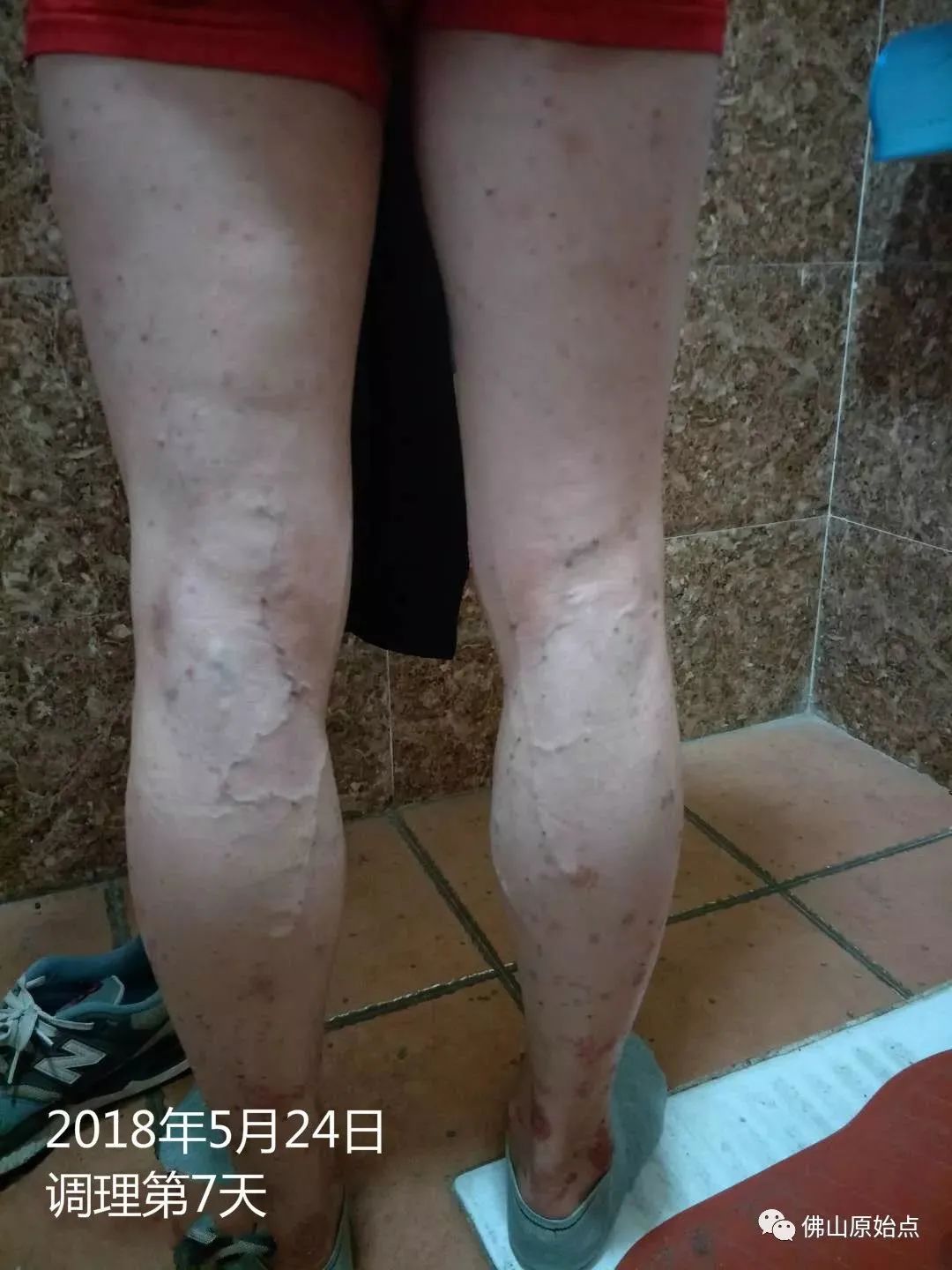 原始点调理严重牛皮癣及静脉曲张:84天完好如初 原始点调理严重牛皮癣及静脉曲张:84天完好如初