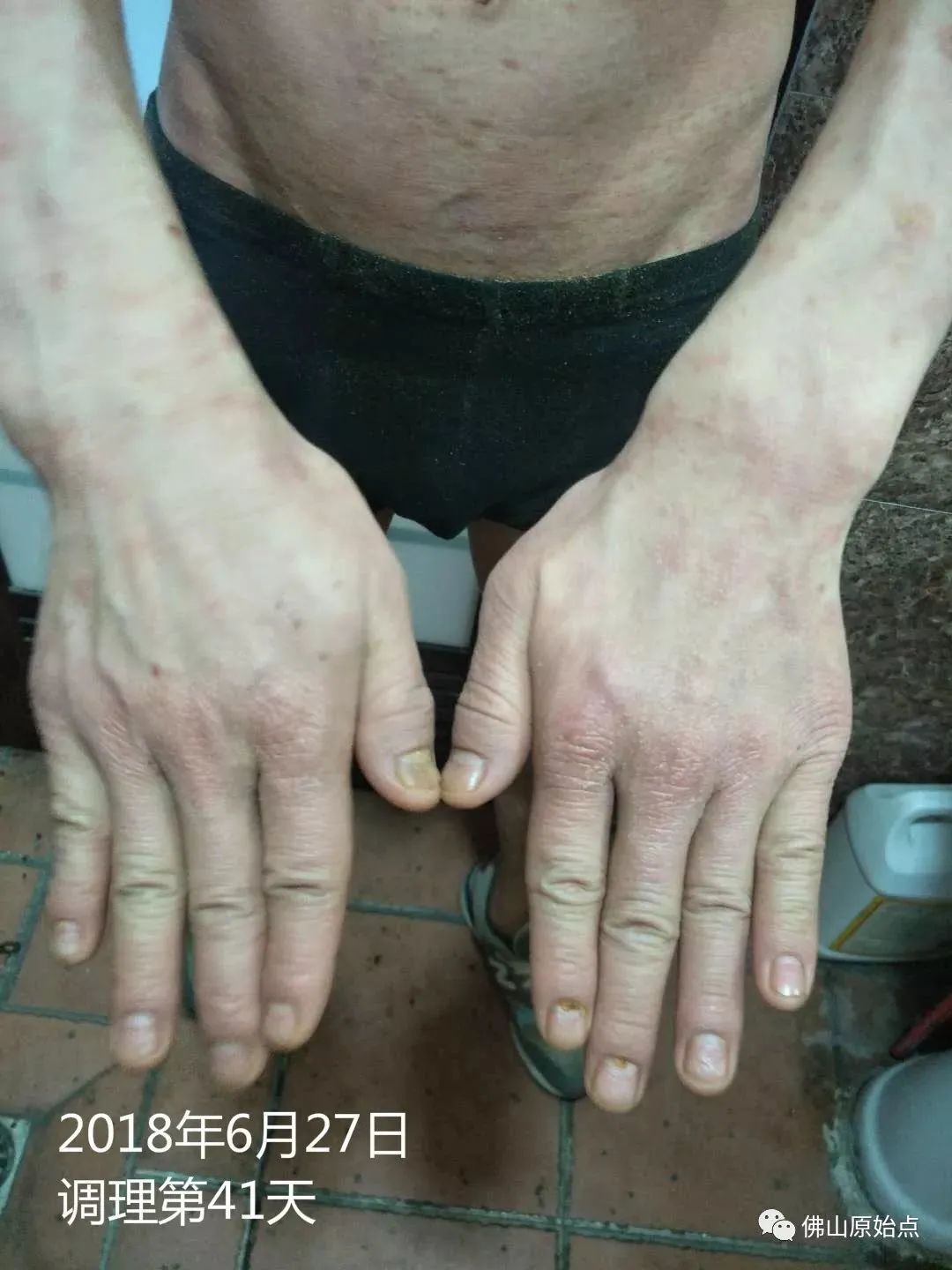 原始点调理严重牛皮癣及静脉曲张:84天完好如初 原始点调理严重牛皮癣及静脉曲张:84天完好如初