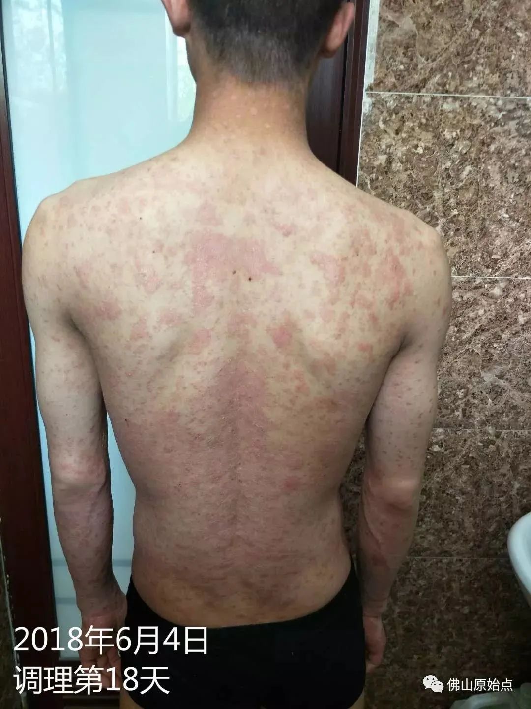 原始点调理严重牛皮癣及静脉曲张:84天完好如初 原始点调理严重牛皮癣及静脉曲张:84天完好如初