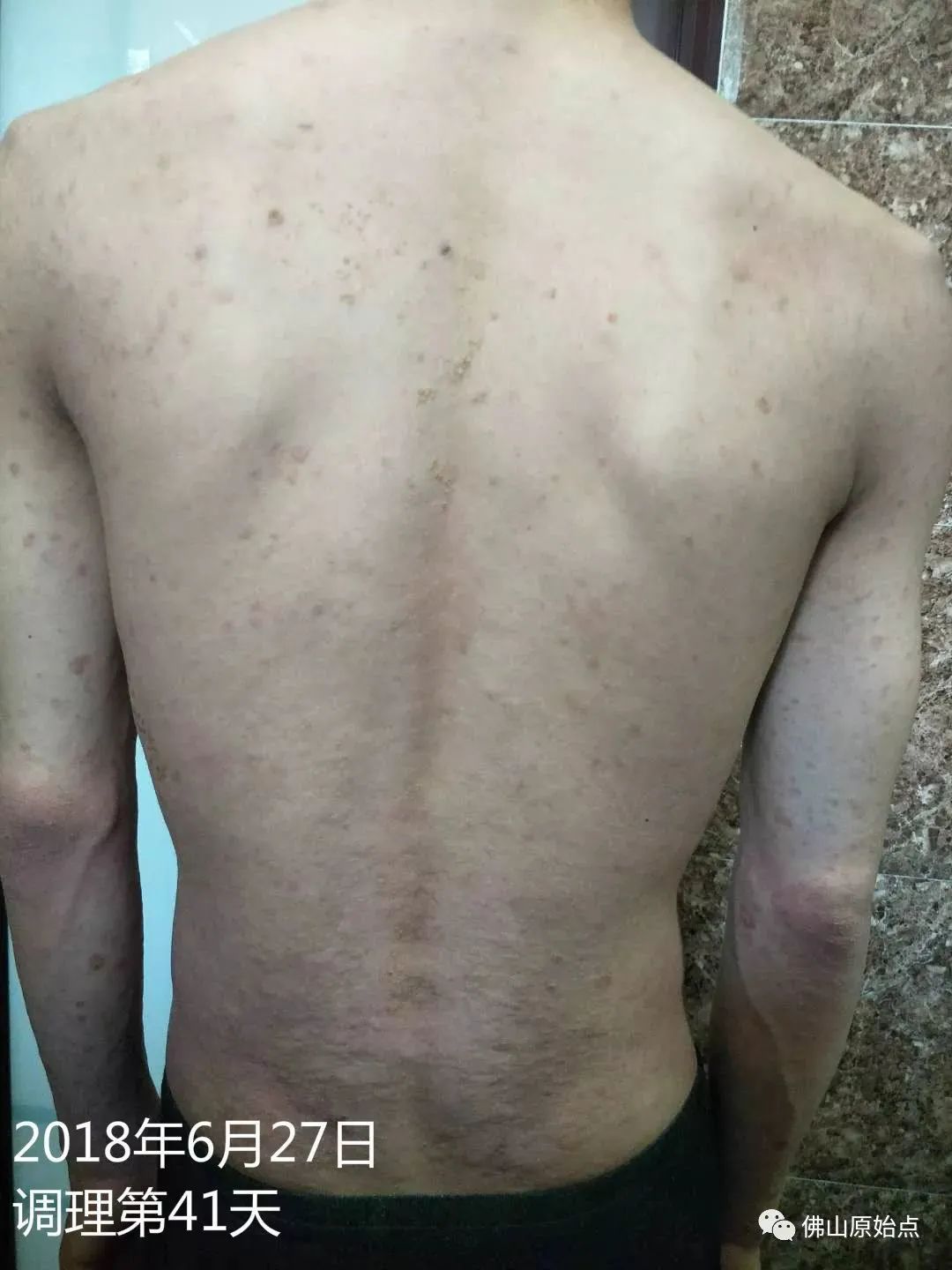 原始点调理严重牛皮癣及静脉曲张:84天完好如初 原始点调理严重牛皮癣及静脉曲张:84天完好如初