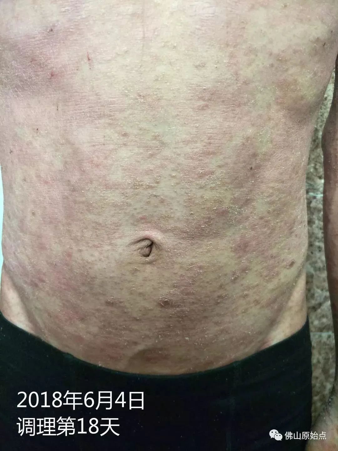 原始点调理严重牛皮癣及静脉曲张:84天完好如初 原始点调理严重牛皮癣及静脉曲张:84天完好如初