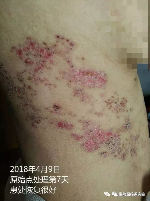 带状疱疹案例两则 带状疱疹案例两则
