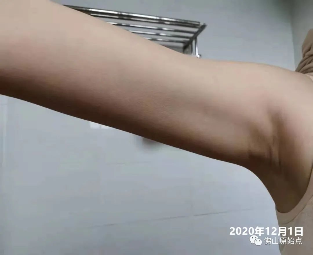 原始点调理红斑荨麻疹案例 原始点调理红斑荨麻疹案例