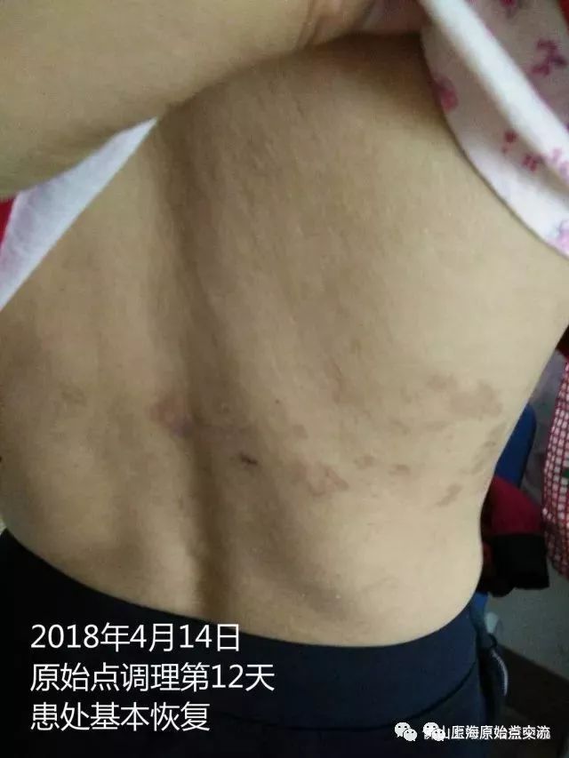 带状疱疹案例两则 带状疱疹案例两则