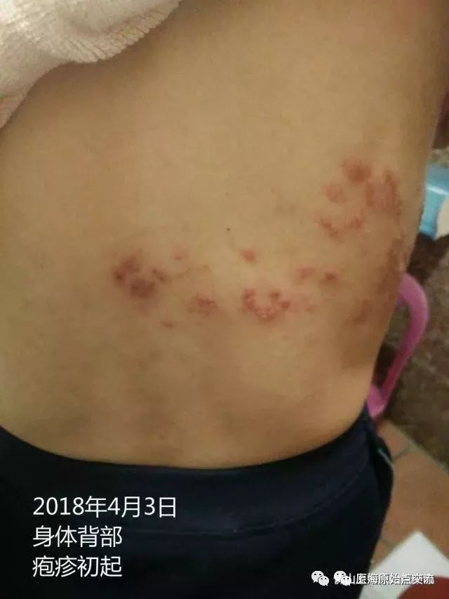 带状疱疹案例两则 带状疱疹案例两则