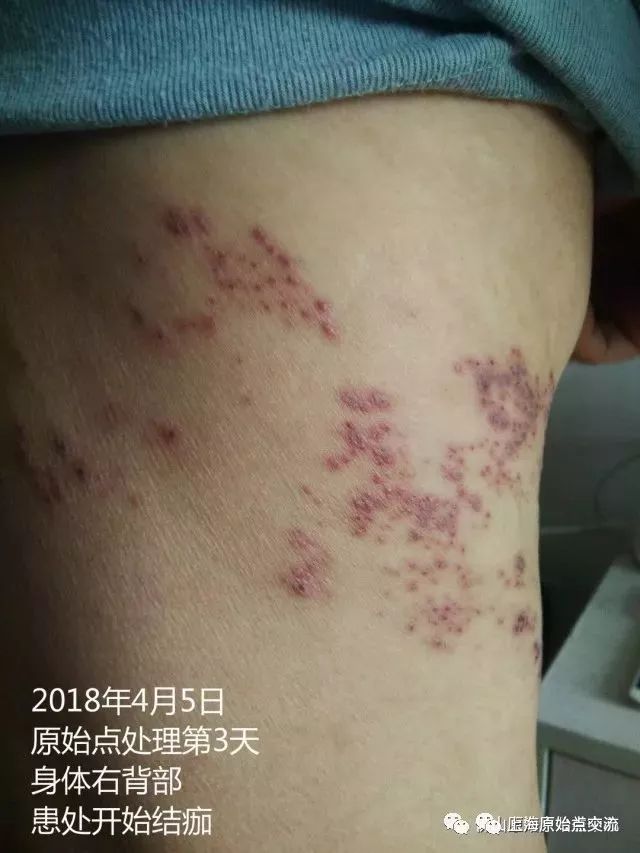 带状疱疹案例两则 带状疱疹案例两则