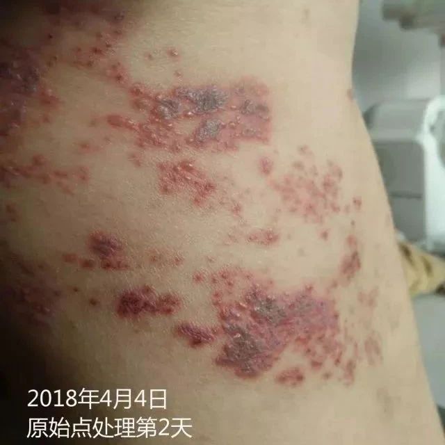 带状疱疹案例两则-原始点全球同学网