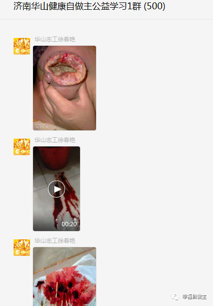 济南华山群分享:乳癌等案例 济南华山群分享:乳癌等案例