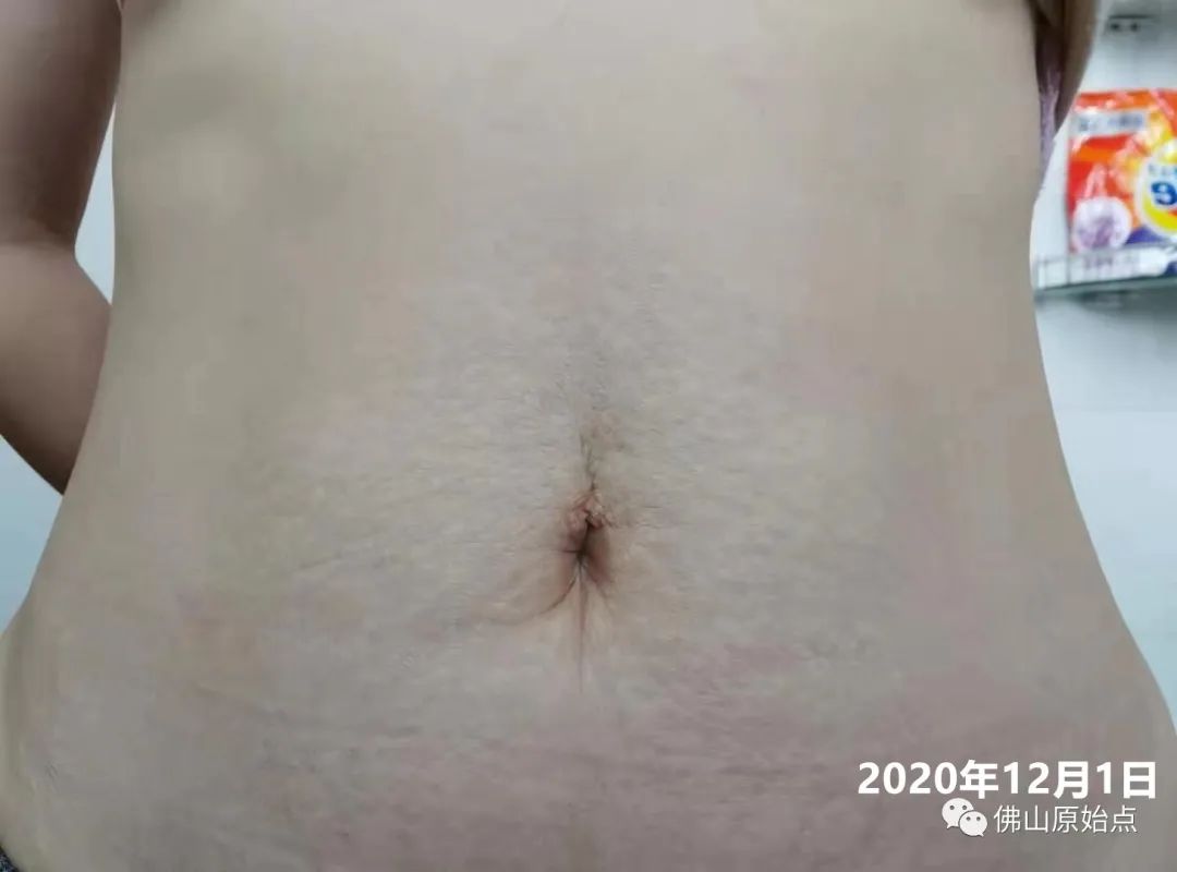 原始点调理红斑荨麻疹案例 原始点调理红斑荨麻疹案例