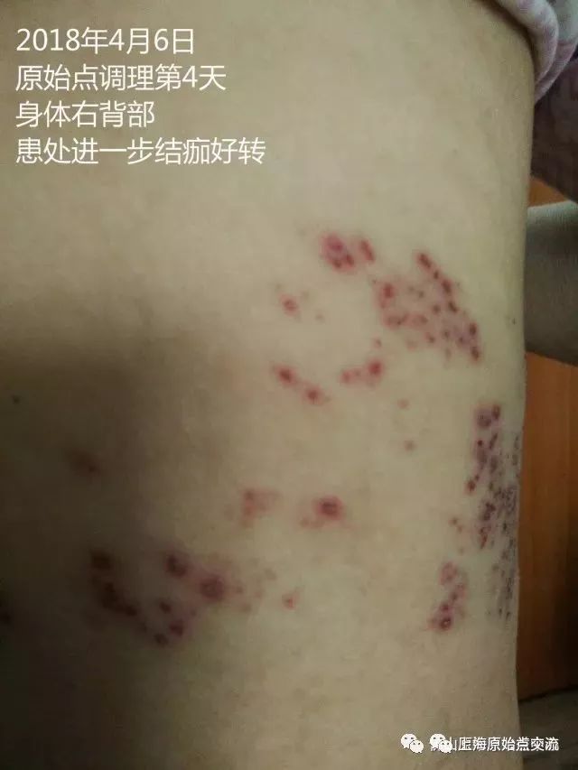 带状疱疹案例两则 带状疱疹案例两则