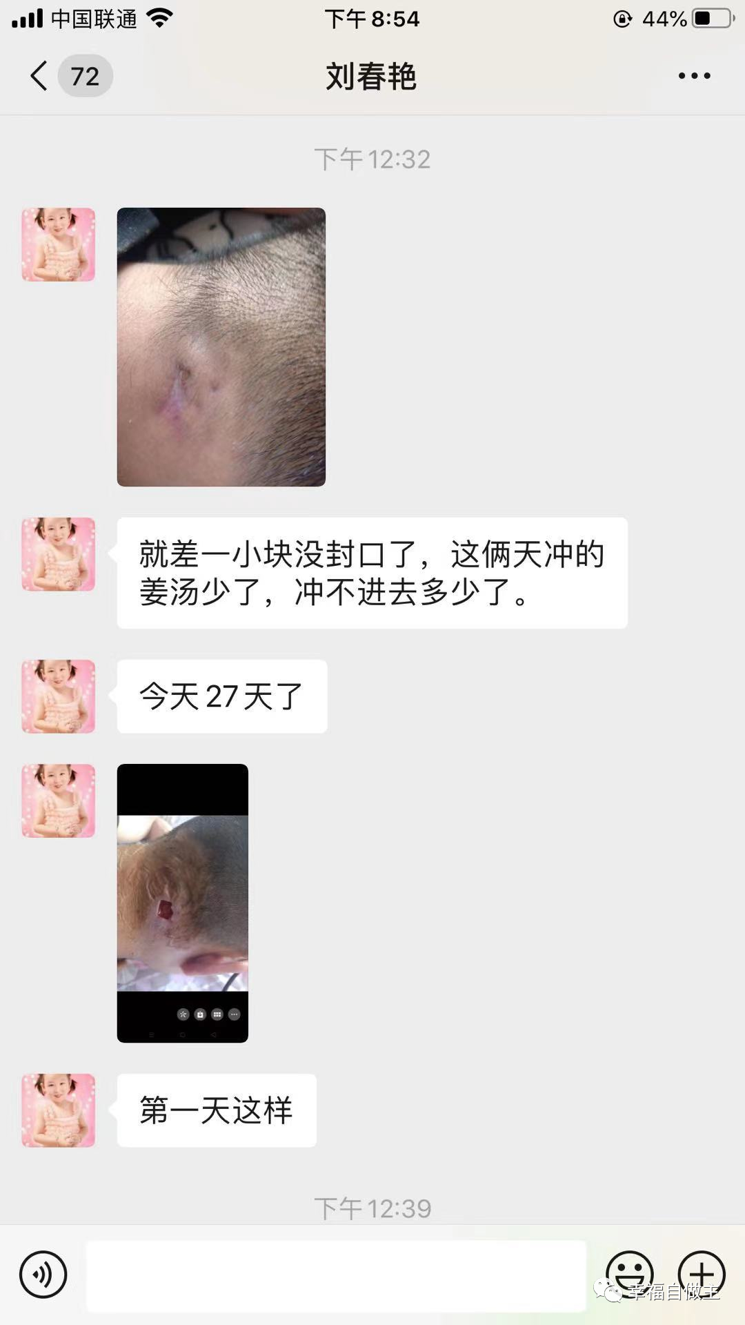 群分享：颈部破口恢复案例，富贵包治疗方法，脚扭伤案例，咳嗽案例