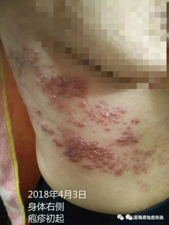 带状疱疹案例两则 带状疱疹案例两则