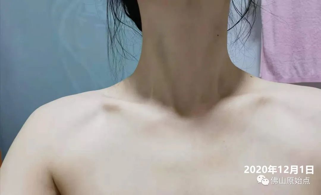 原始点调理红斑荨麻疹案例 原始点调理红斑荨麻疹案例