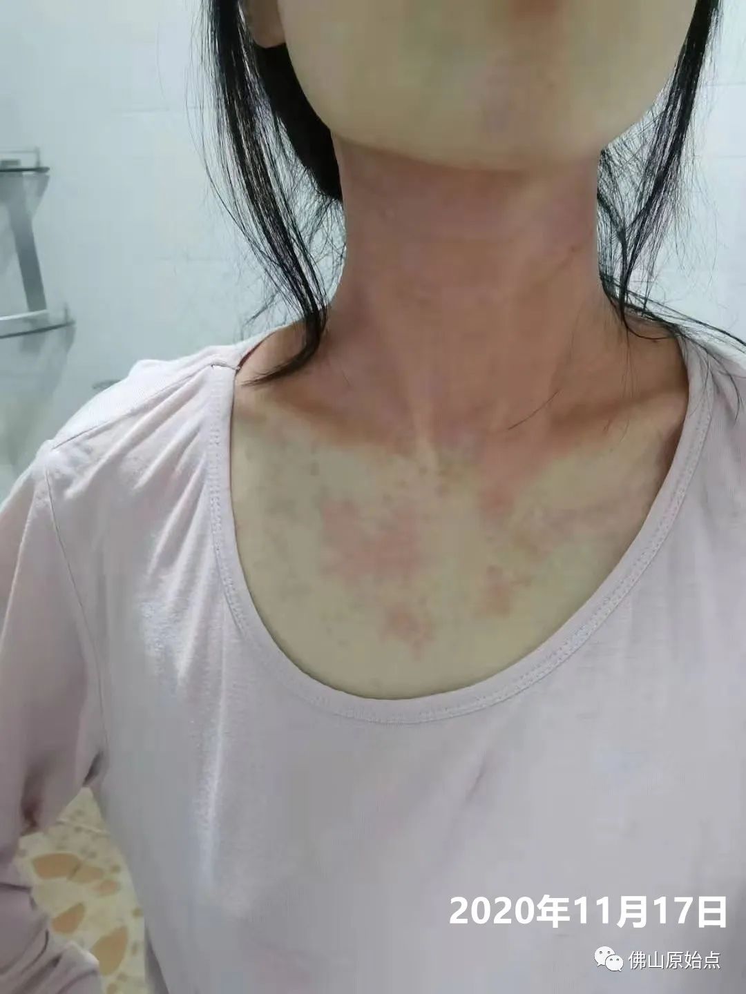 原始点调理红斑荨麻疹案例 原始点调理红斑荨麻疹案例