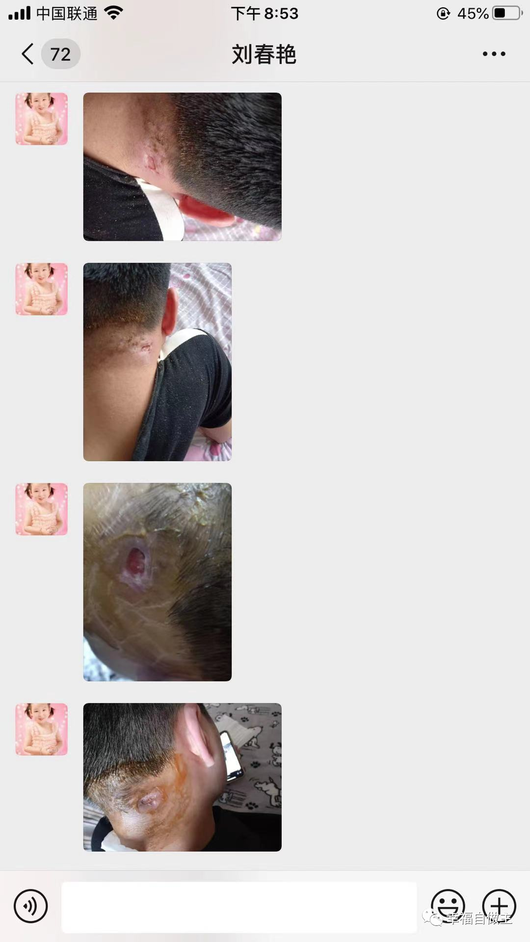 群分享：颈部破口恢复案例，富贵包治疗方法，脚扭伤案例，咳嗽案例