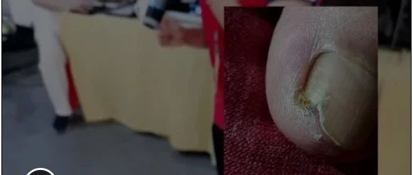 脚拇指碰伤发黑化脓到康复---有效热才有效 20210620-原始点全球同学网