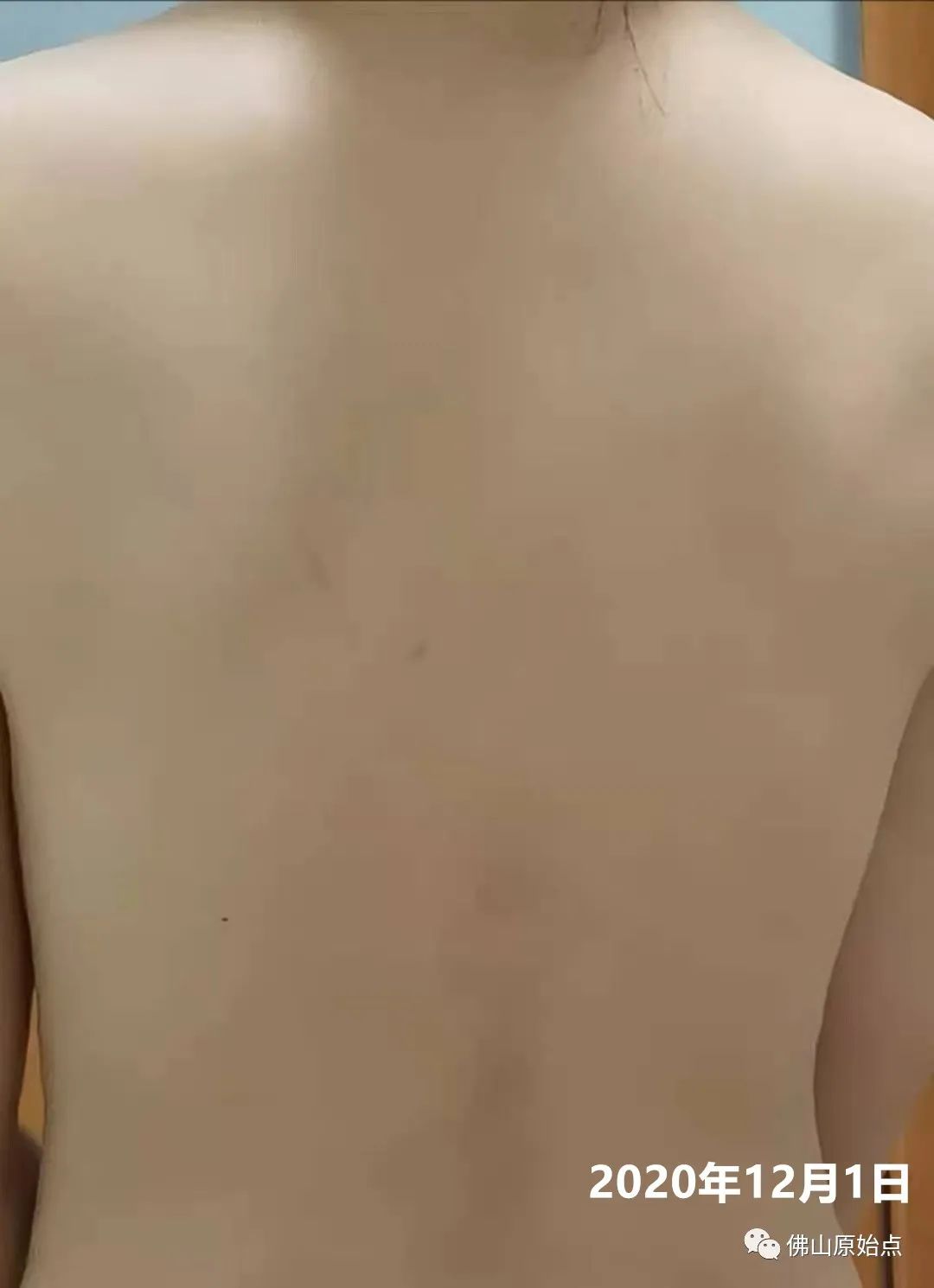 原始点调理红斑荨麻疹案例 原始点调理红斑荨麻疹案例