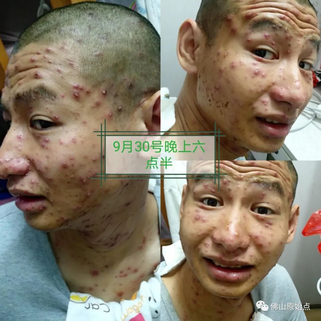 原始点调理水痘案例 原始点调理水痘案例
