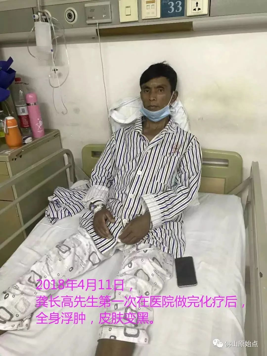 原始点调理浆细胞型巨大淋巴结增生病（CastIeman病）案例-原始点全球同学网