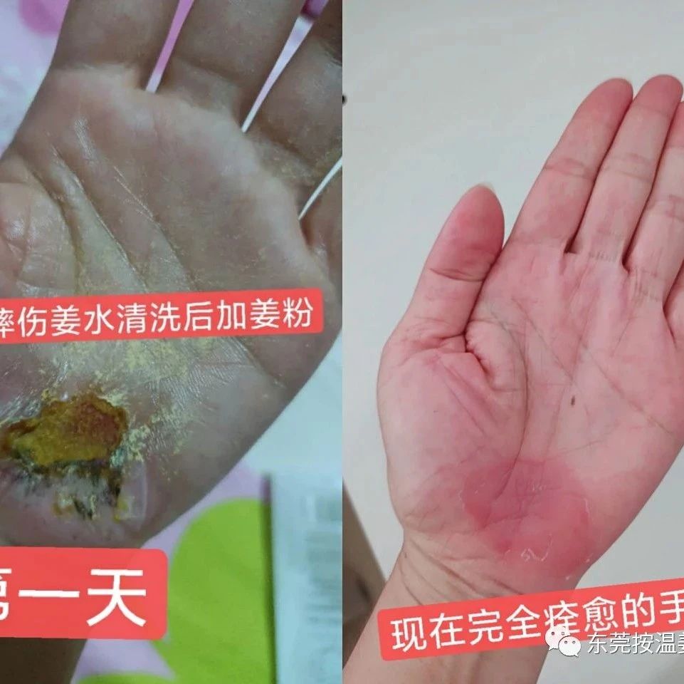 《被电瓶车撞跌倒案例》跟进-原始点全球同学网