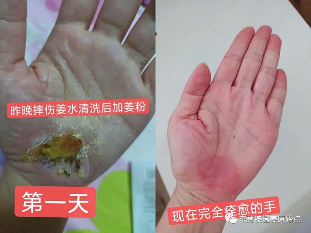 《被电瓶车撞跌倒案例》跟进 《被电瓶车撞跌倒案例》跟进