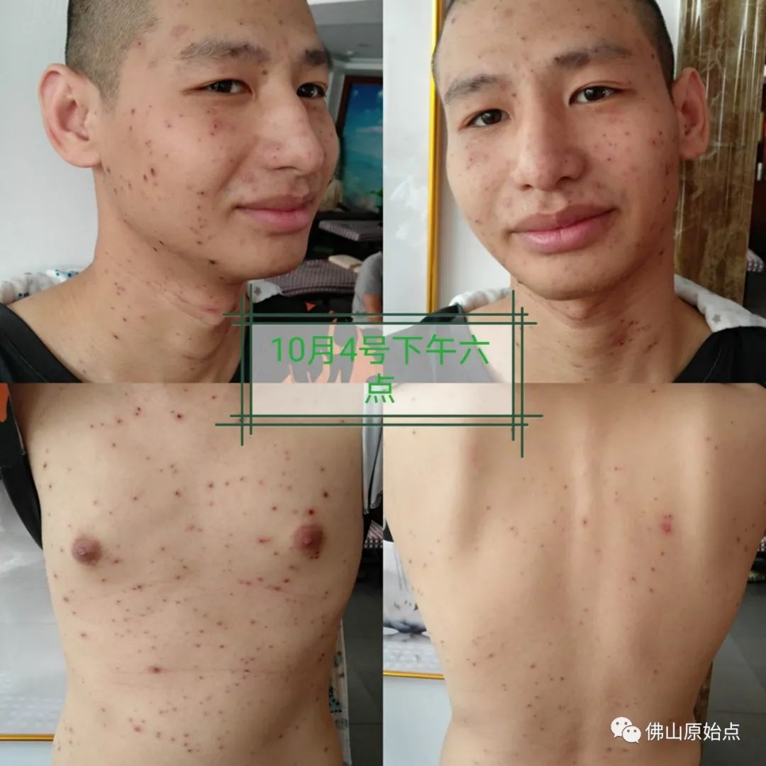 原始点调理水痘案例 原始点调理水痘案例