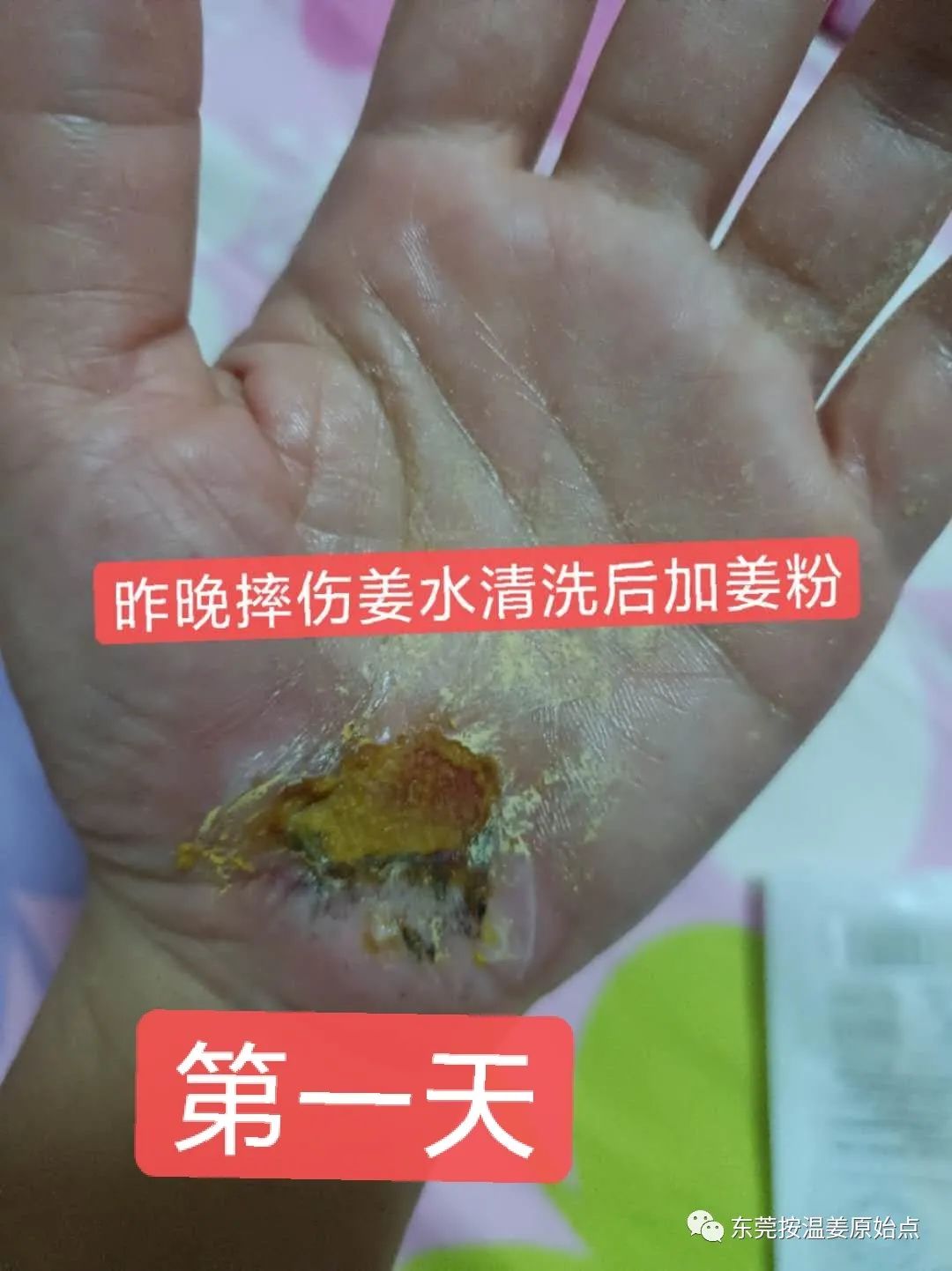 《被电瓶车撞跌倒案例》跟进 《被电瓶车撞跌倒案例》跟进