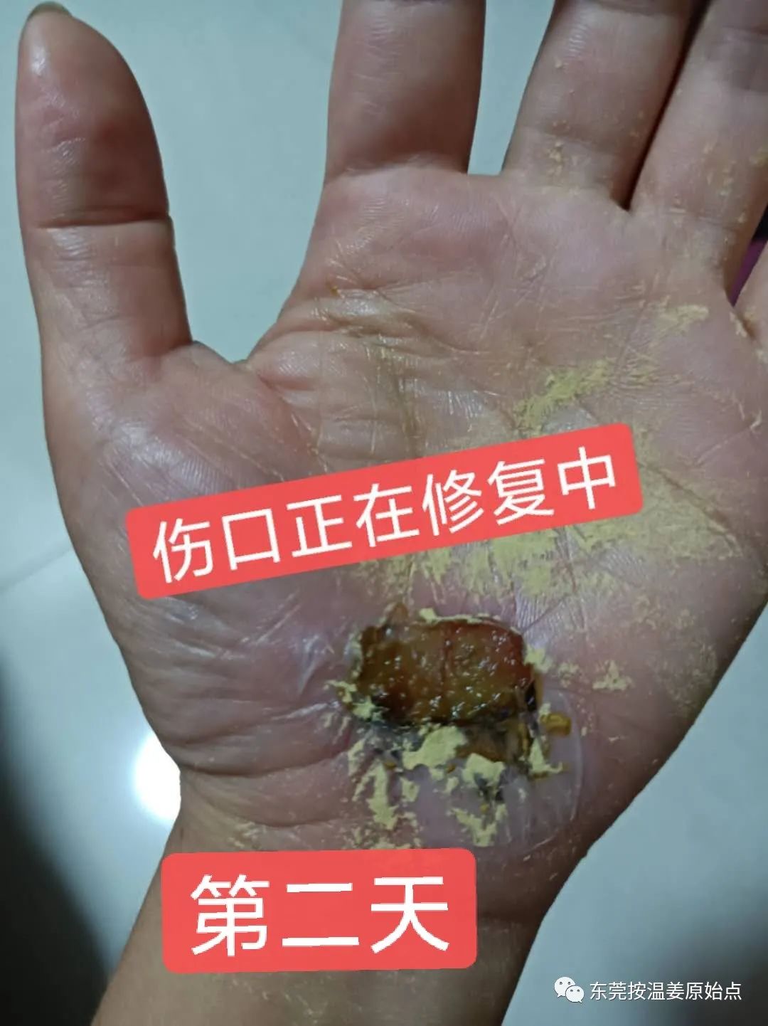 《被电瓶车撞跌倒案例》跟进 《被电瓶车撞跌倒案例》跟进