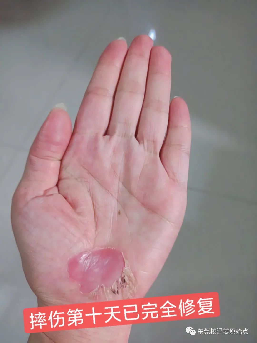 《被电瓶车撞跌倒案例》跟进 《被电瓶车撞跌倒案例》跟进