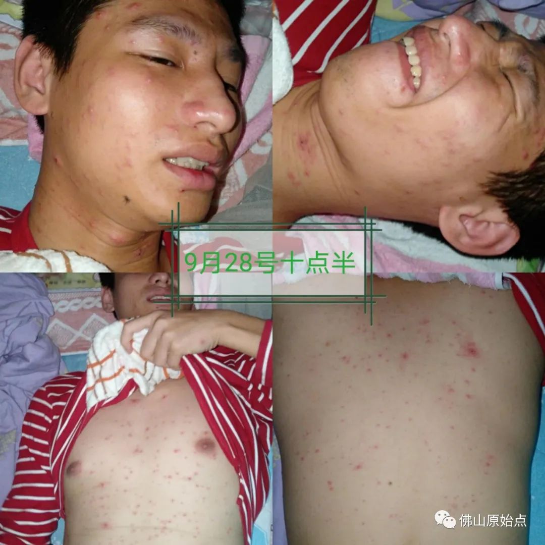 原始点调理水痘案例 原始点调理水痘案例