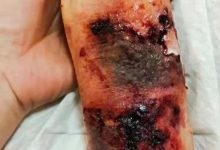 胳膊摔伤案例-原始点全球同学网