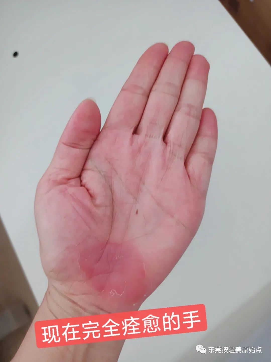 《被电瓶车撞跌倒案例》跟进 《被电瓶车撞跌倒案例》跟进