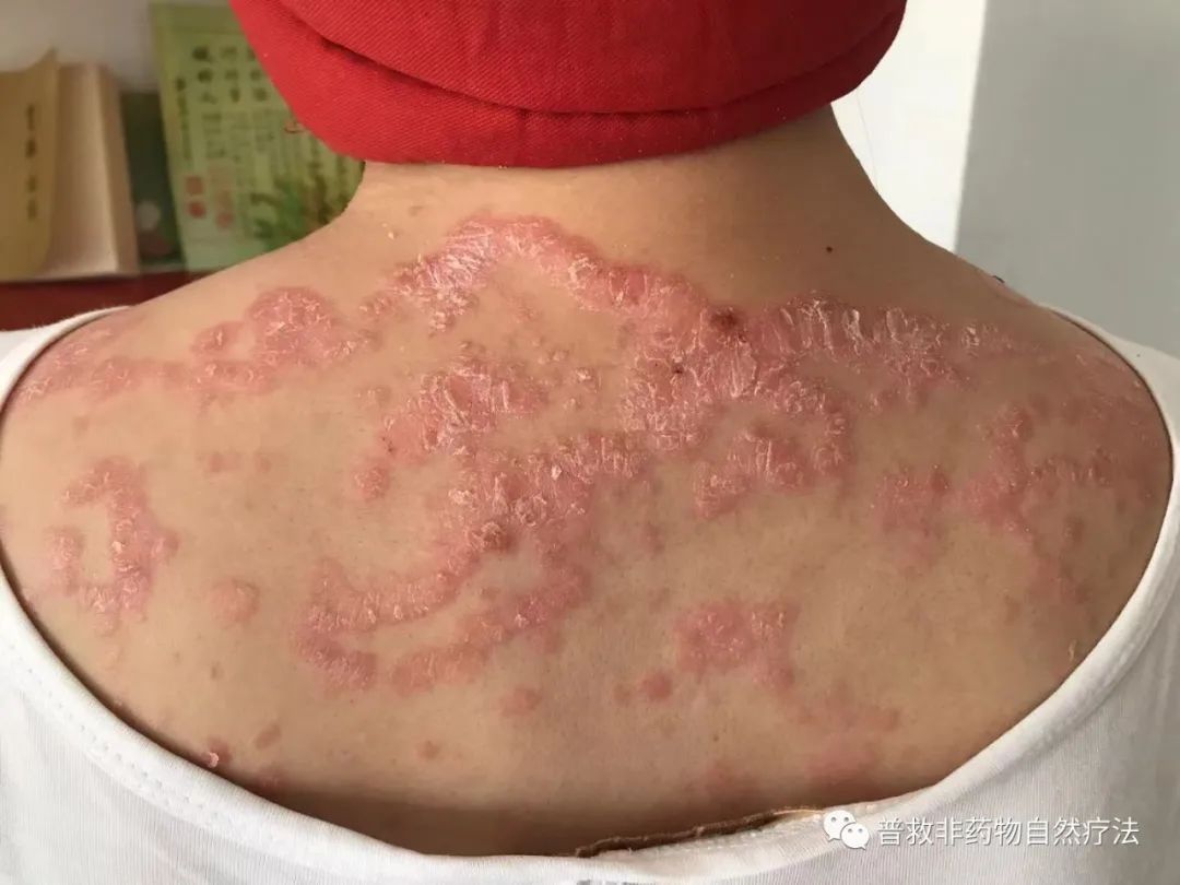 2019年全身爆发牛皮癣案例后续