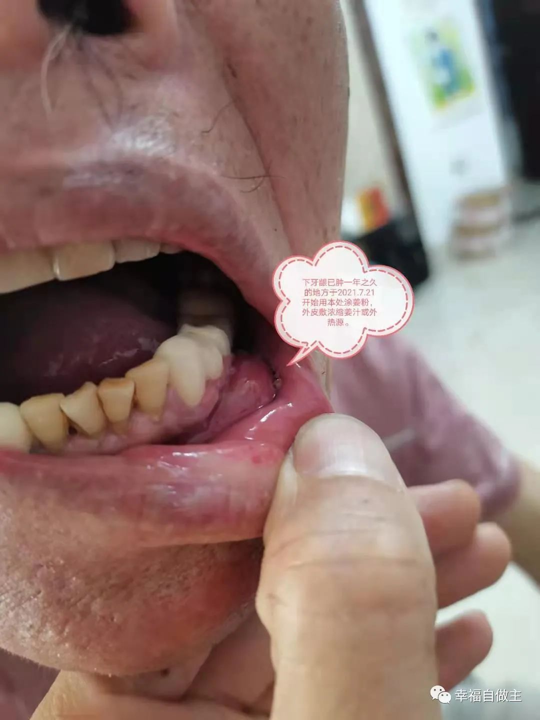 牙龈肿瘤、脑梗死案例