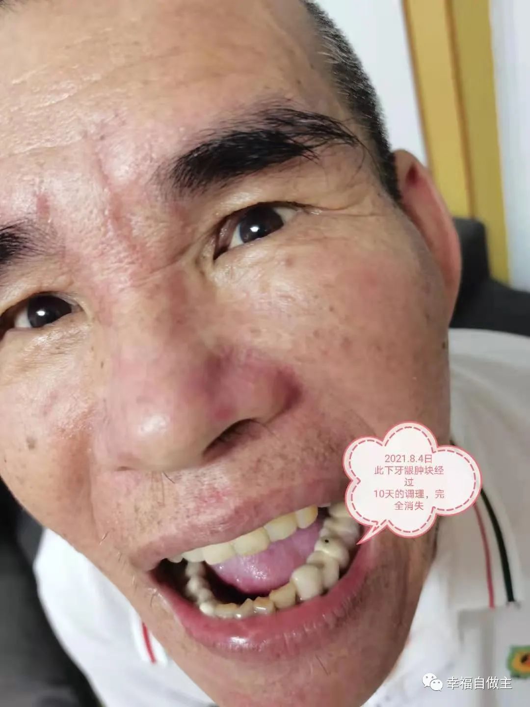 牙龈肿瘤、脑梗死案例