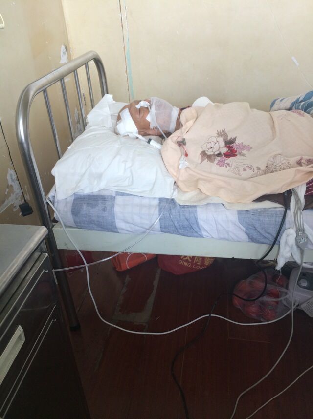 82岁老人车祸康复案例-硬膜撕裂伤、硬膜下水肿，双侧胸腔积液，坠积性肺炎，耻骨联合骨折，全身多处血肿、软组织损伤，低蛋白及贫血。