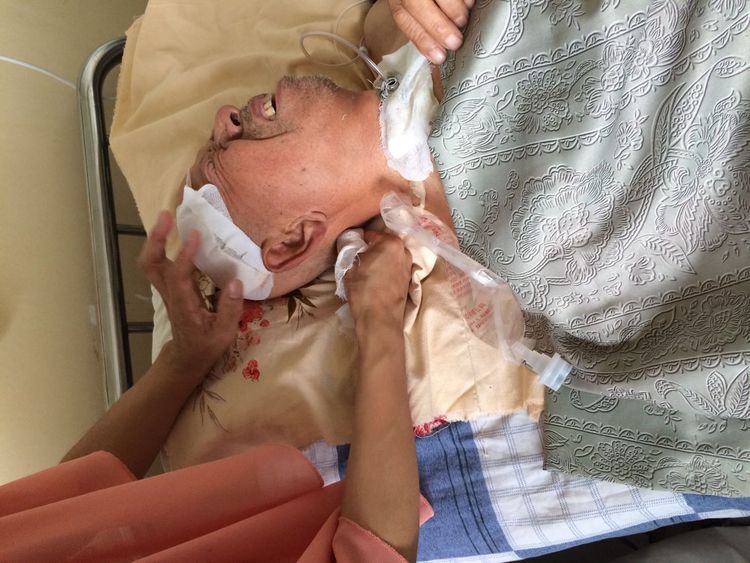 82岁老人车祸康复案例-硬膜撕裂伤、硬膜下水肿，双侧胸腔积液，坠积性肺炎，耻骨联合骨折，全身多处血肿、软组织损伤，低蛋白及贫血。