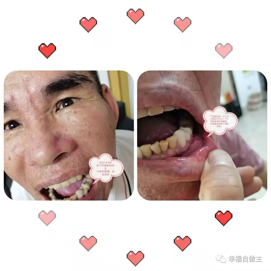 牙龈肿瘤、脑梗死案例