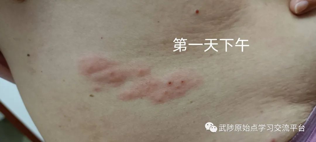 带状疱疹案例 带状疱疹案例