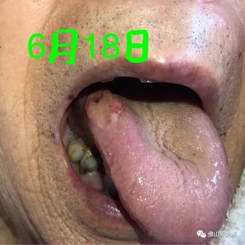 原始点调理疑似舌癌:简单相信实干收获快 原始点调理疑似舌癌:简单相信实干收获快