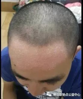 原始点调理九年史牛皮癣:二十天大变化 原始点调理九年史牛皮癣:二十天大变化