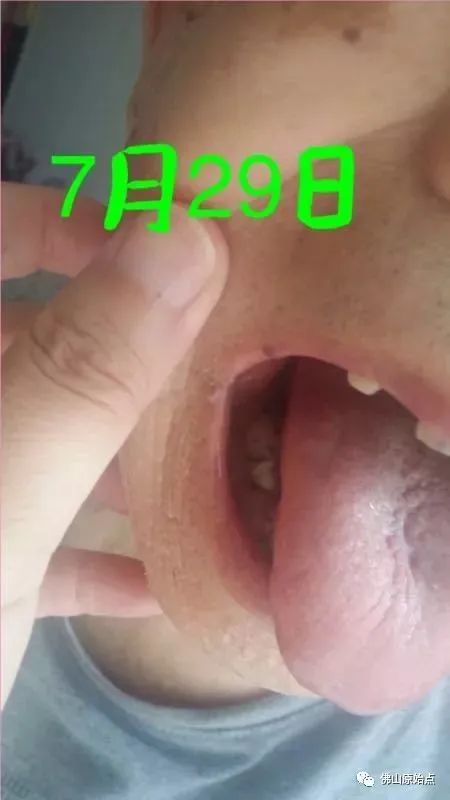 原始点调理疑似舌癌:简单相信实干收获快 原始点调理疑似舌癌:简单相信实干收获快
