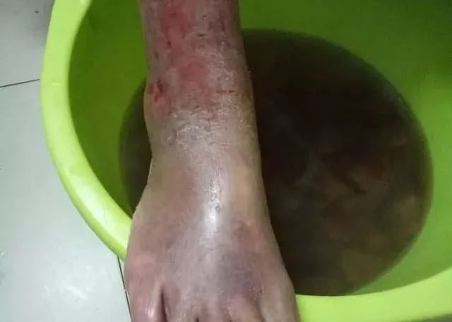 原始点调理全身肿胀溃烂:九个月,雨过天睛 原始点调理全身肿胀溃烂:九个月,雨过天睛
