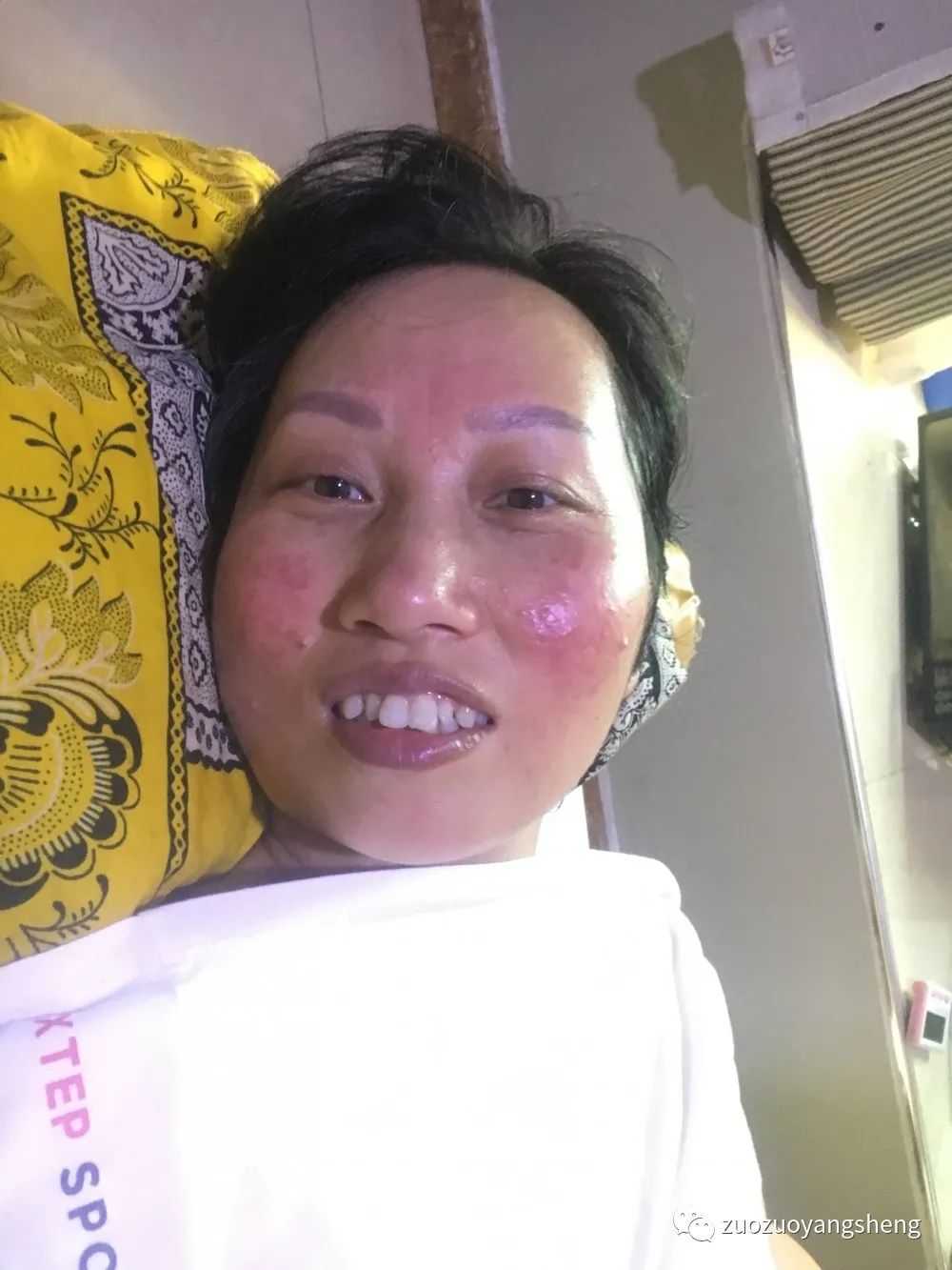 案例分享:原始点调理脸上严重玫瑰痤疮的案例 案例分享:原始点调理脸上严重玫瑰痤疮的案例