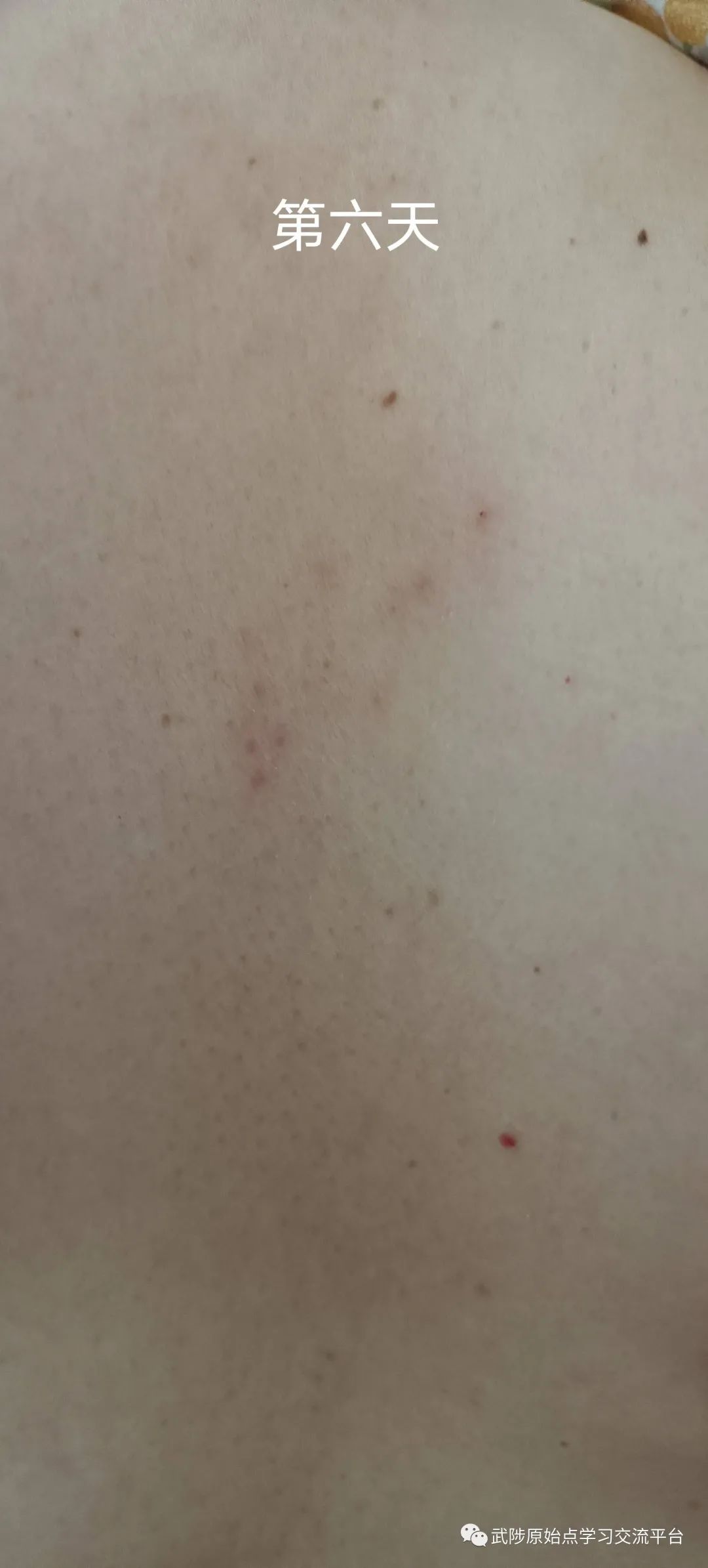 带状疱疹案例 带状疱疹案例